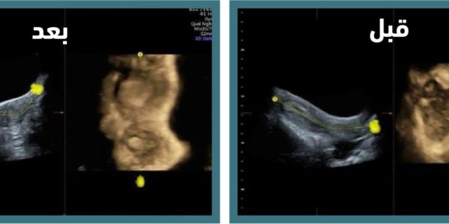 جراحة تُنهي معاناة فتاة من "رحم وحيد القرن" النادر - اليوم الإخباري